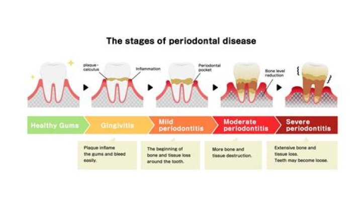 Can you be healthy with periodontitis?