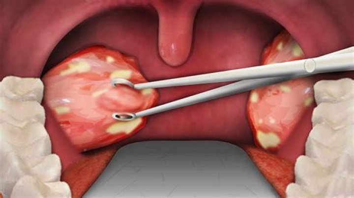 Can you brush teeth after tonsillectomy?