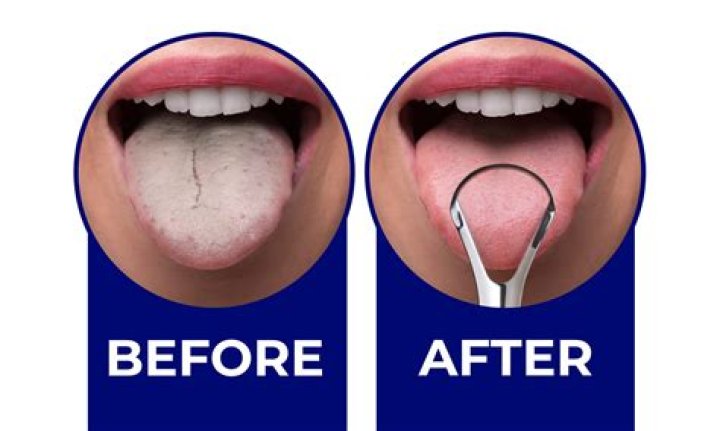 Can you brush your teeth after tonsillectomy?