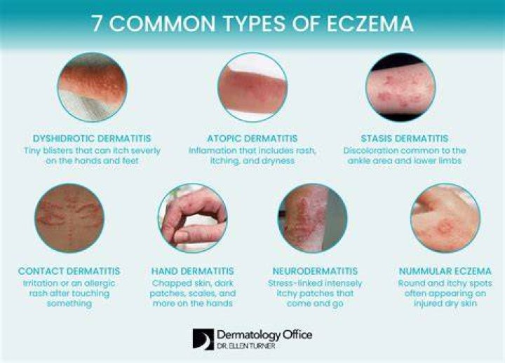 Can you eat chocolate if you have eczema?