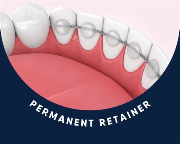 Can you eat steak with a permanent retainer?