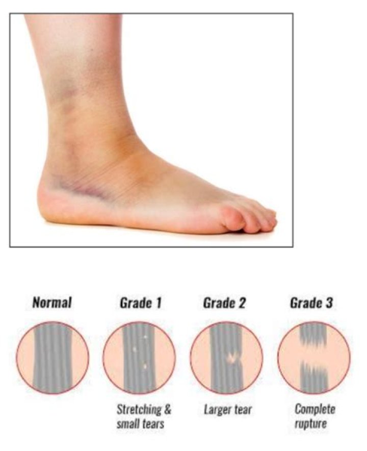 Can you fully recover from a grade 3 ankle sprain?