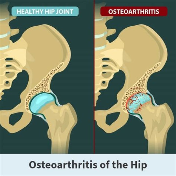 Can you have osteoarthritis throughout your whole body?