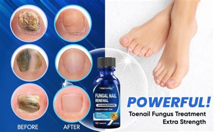 Can you have toenail fungus for years?