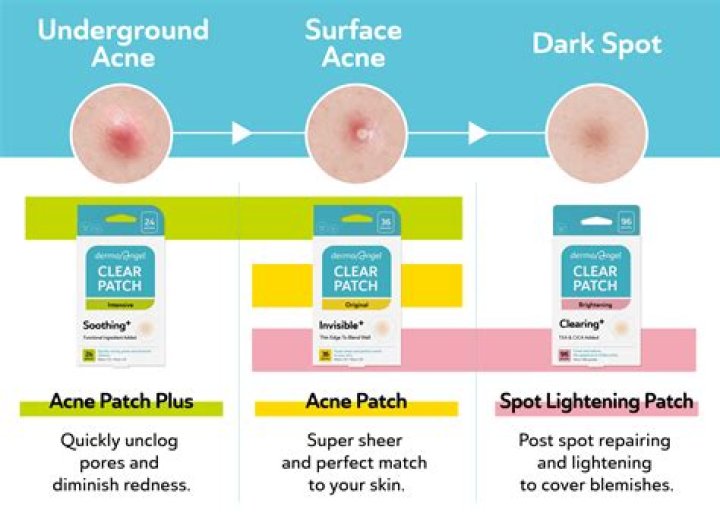 Can you leave aspirin on pimple overnight?