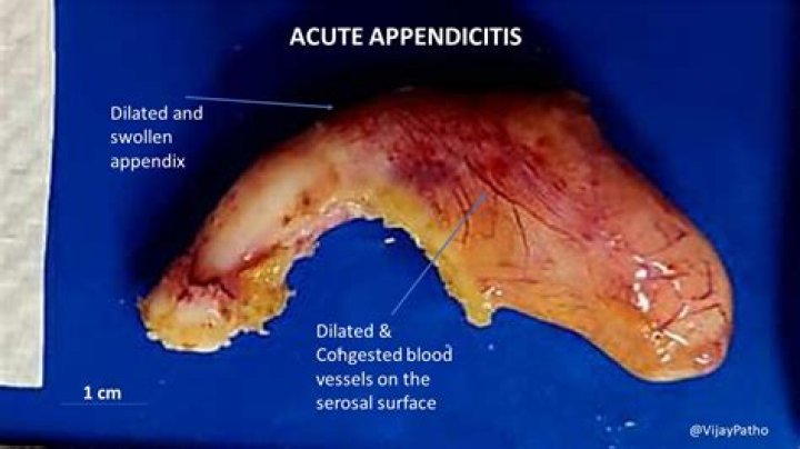 Can you poop with appendicitis?