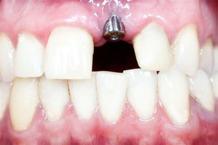 Can you put implants in front teeth?