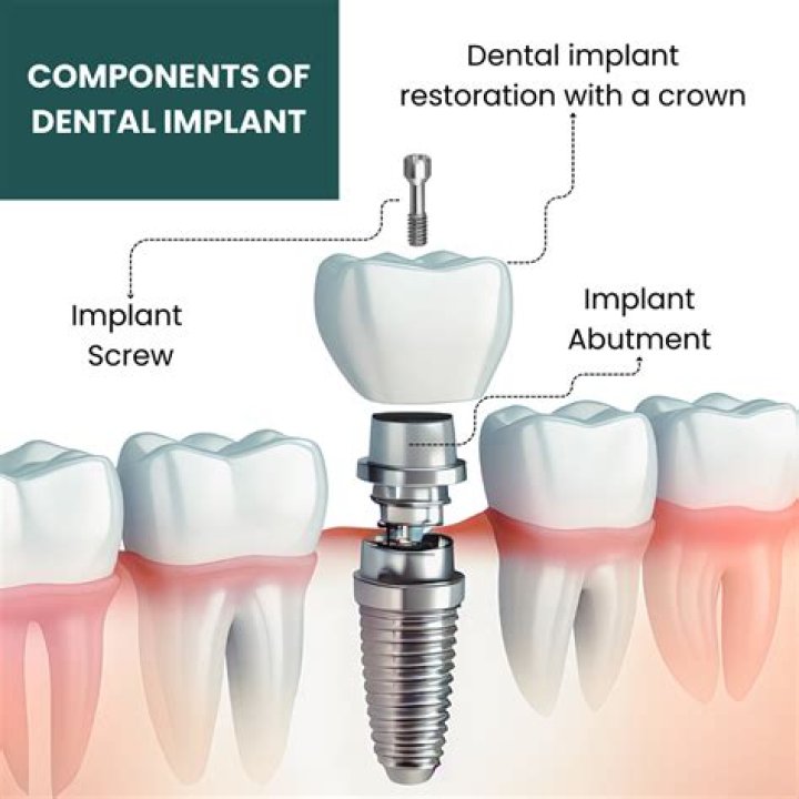 Can you put two dental implants next to each other?