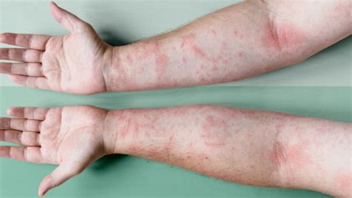 Can you randomly get dermatitis?