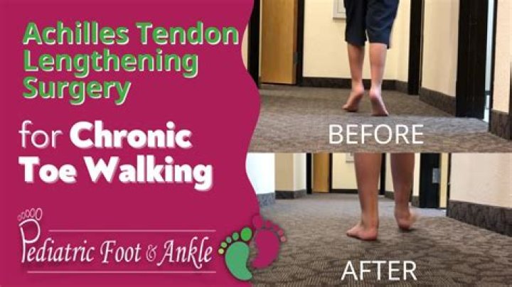 Can you walk after toe shortening surgery?