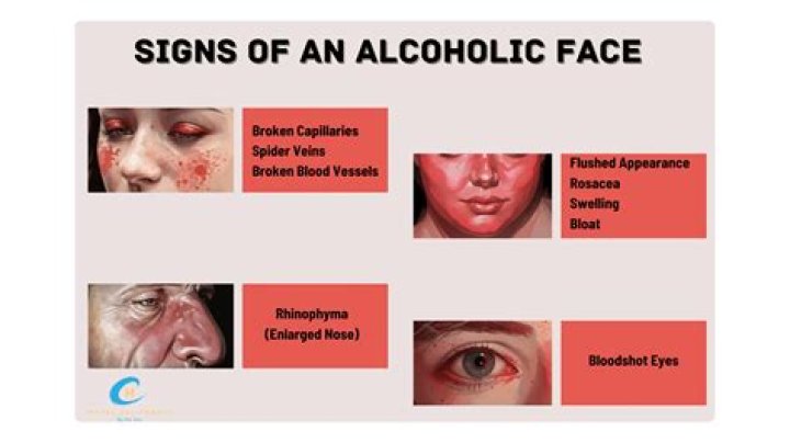 Do alcoholics have high blood pressure?