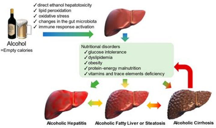 Do all heavy drinkers get fatty liver?
