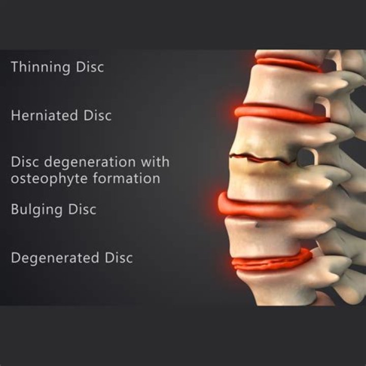 Do all herniated discs need surgery?