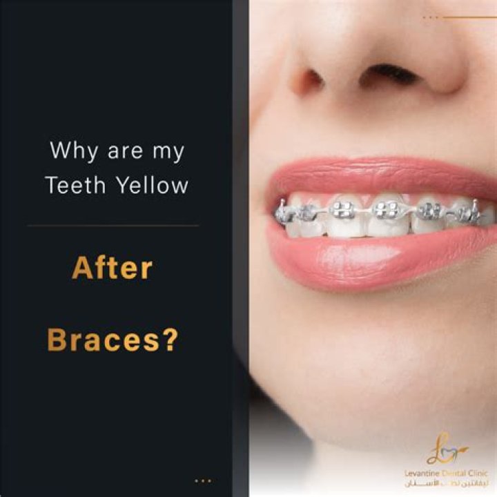 Do braces cause yellow teeth?