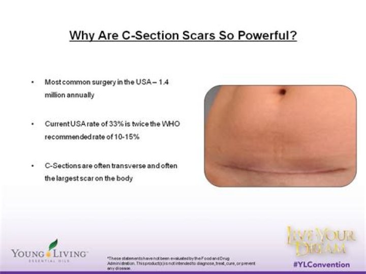 Do C sections hurt?
