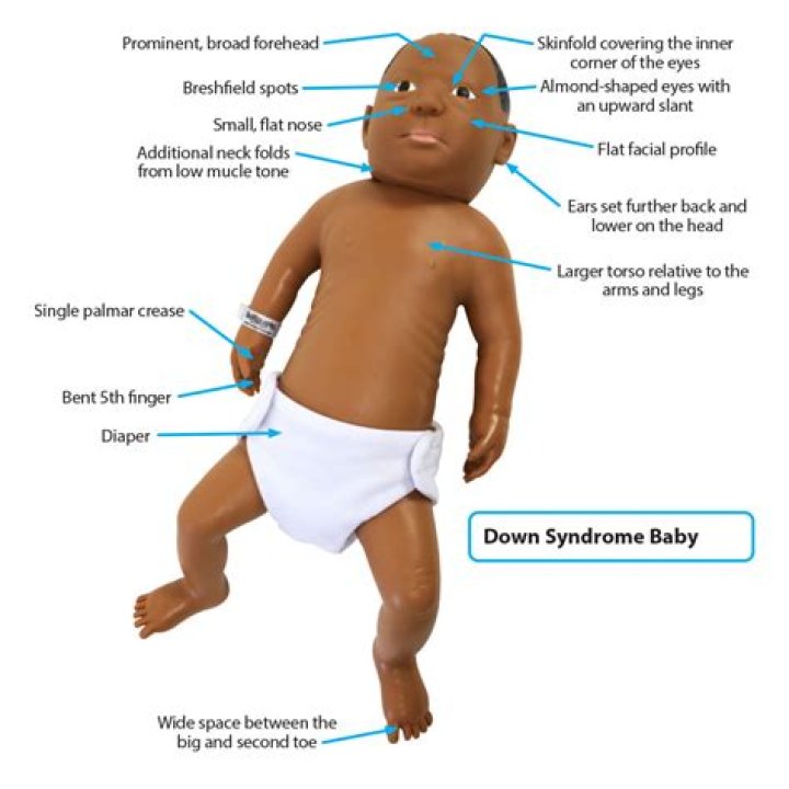 Do Downs babies look normal at birth?