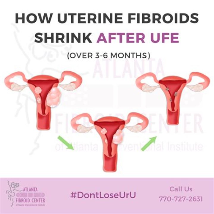 Do fibroids hurt when shrinking?