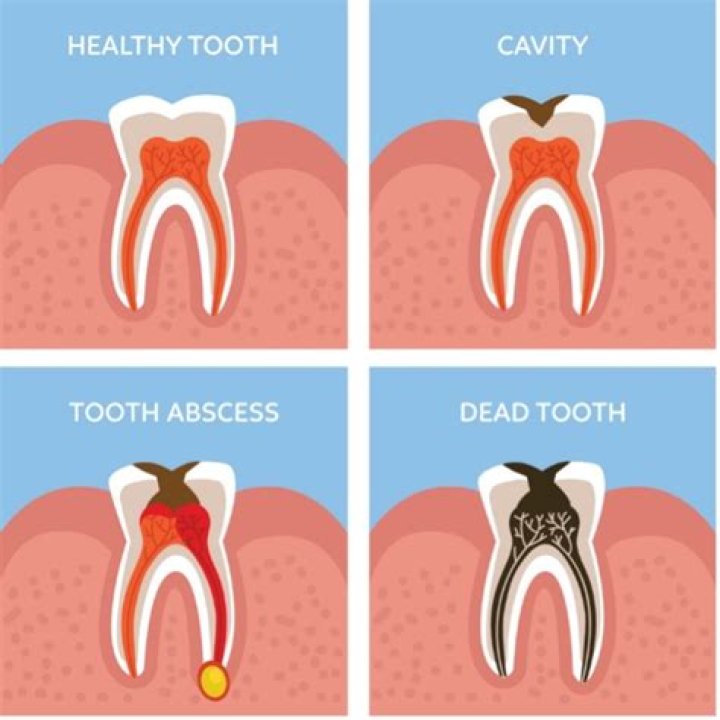 Do I need a root canal if there is no pain?