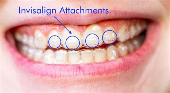 Do Invisalign buttons come off?
