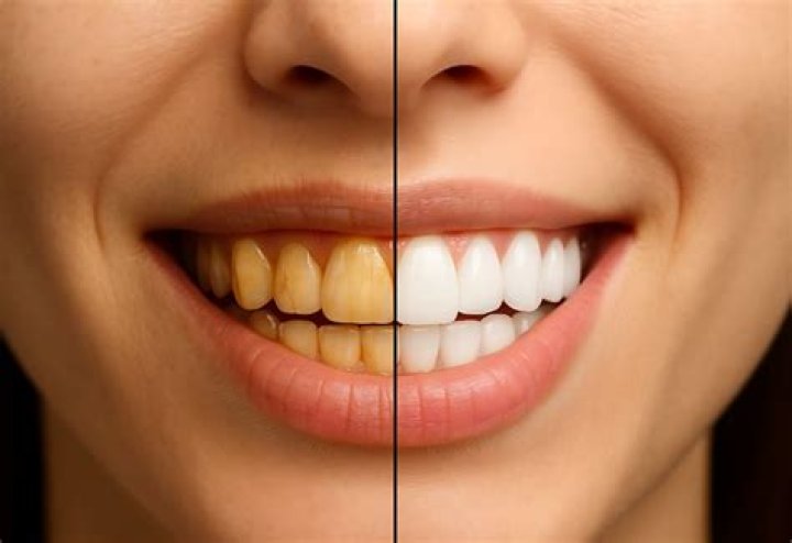 Do lemons make your teeth yellow?