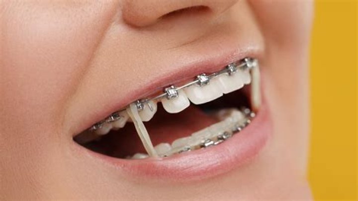 Do teeth stain with braces?