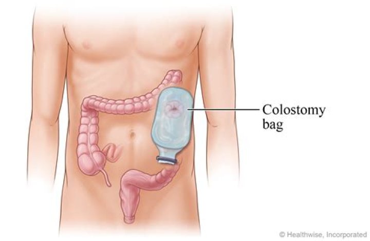 Do you need a colostomy bag after diverticulitis surgery?