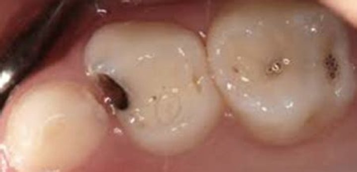 Does a black spot on tooth mean cavity?