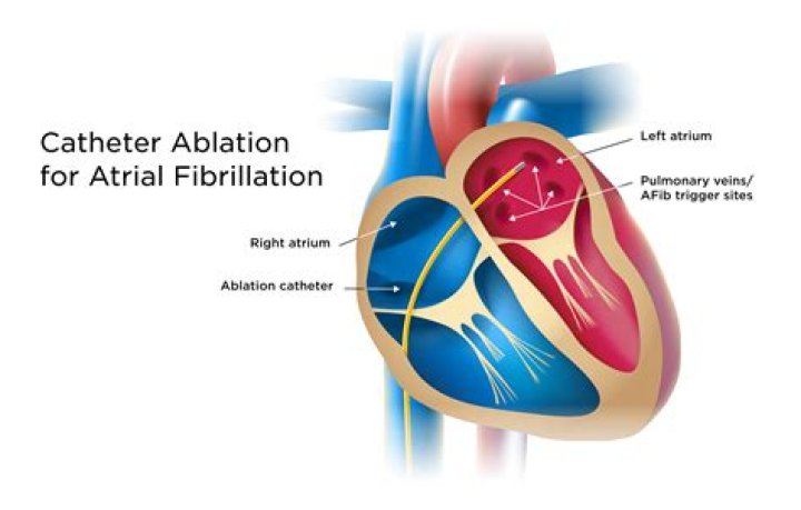 Does a heart ablation shorten your life?