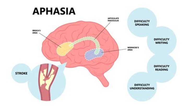 Does aphasia affect swallowing?