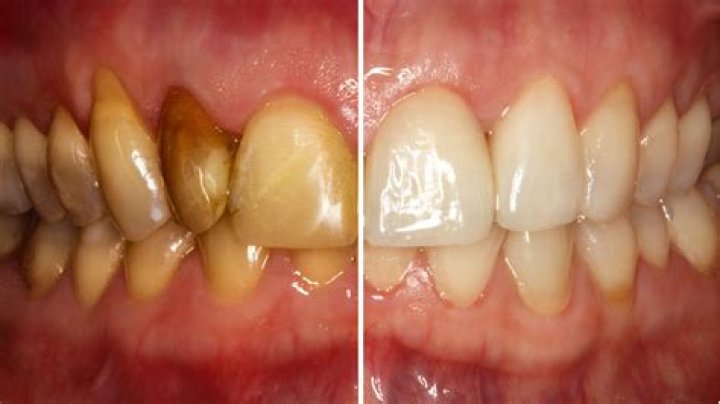Does brushing with baking soda damage enamel?