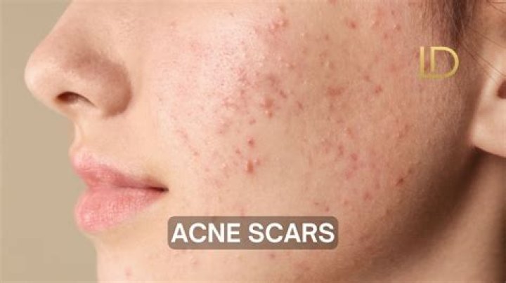 Does dancing cause acne?