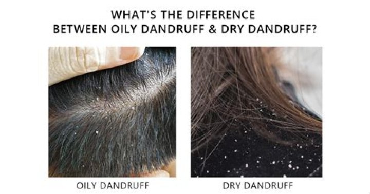 Does dandruff have a smell?