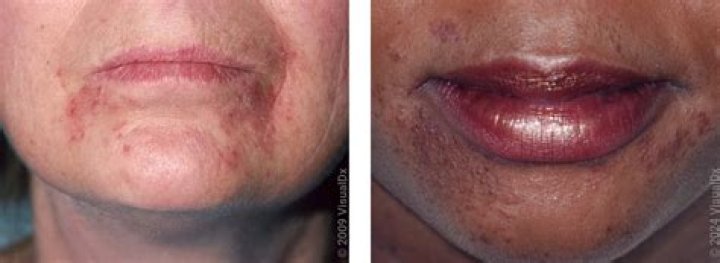 Does eczema get worse before it gets better?