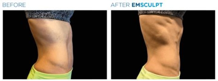Does Emsculpt work on flabby arms?