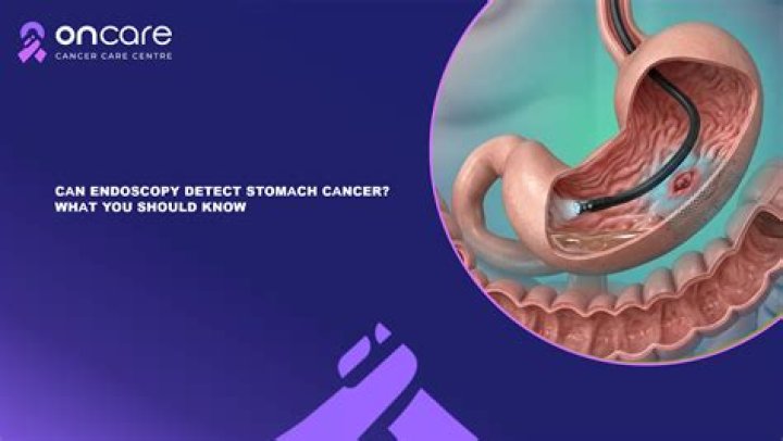 Does endoscopy show stomach cancer?