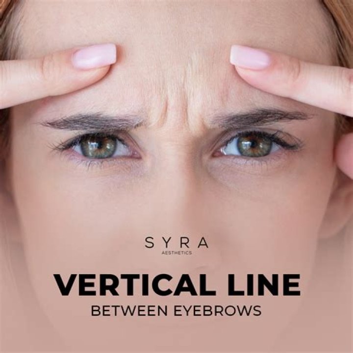Does everyone have hair between their eyebrows?