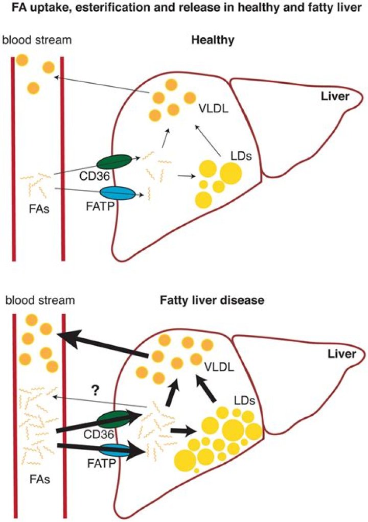 Does fatty liver increase blood pressure?