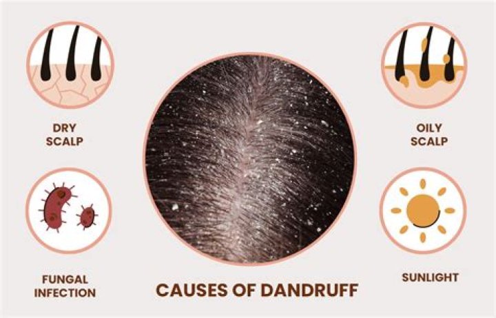 Does hot water cause dandruff?