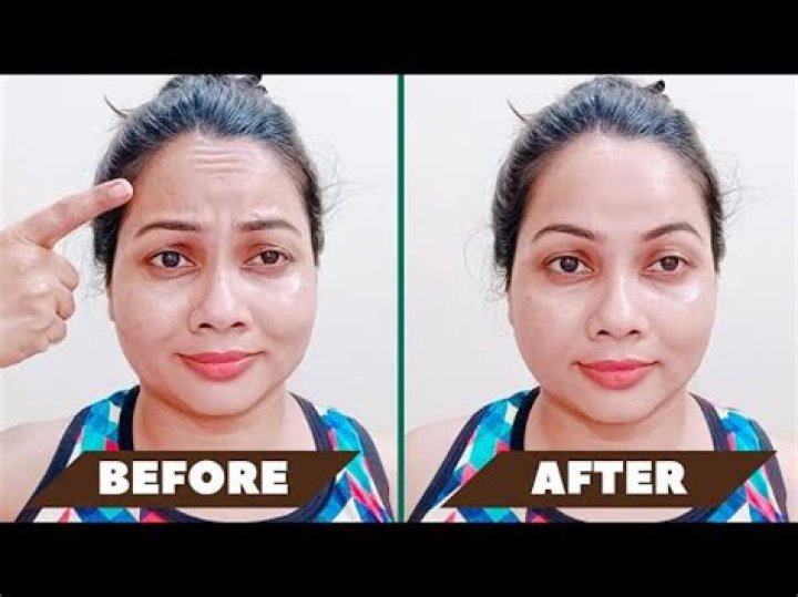 Does massaging forehead help wrinkles?