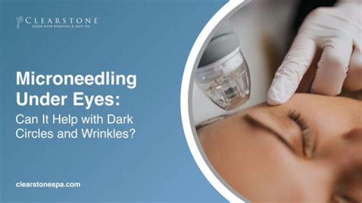 Does microneedling help under eye hollows?