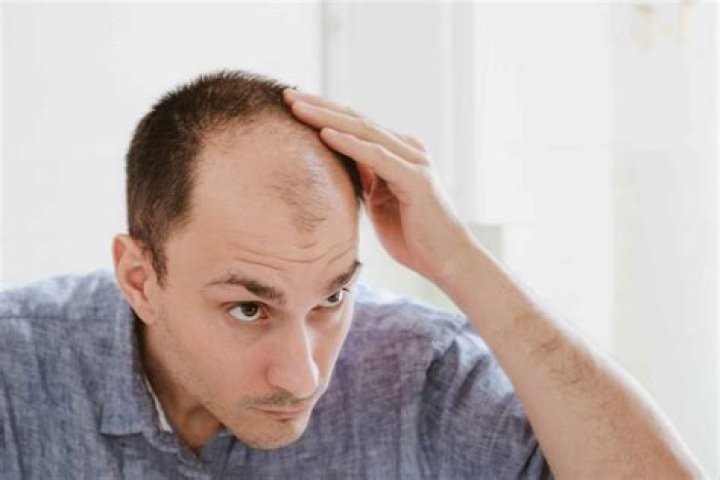 Does milk make you bald?
