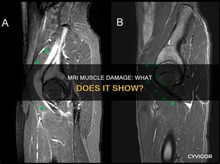 Does MRI show muscle inflammation?