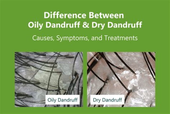 Does olive oil cause dandruff?