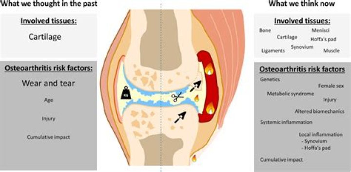 Does osteoarthritis reduce lifespan?