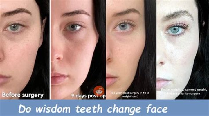 Does removing teeth change face shape?