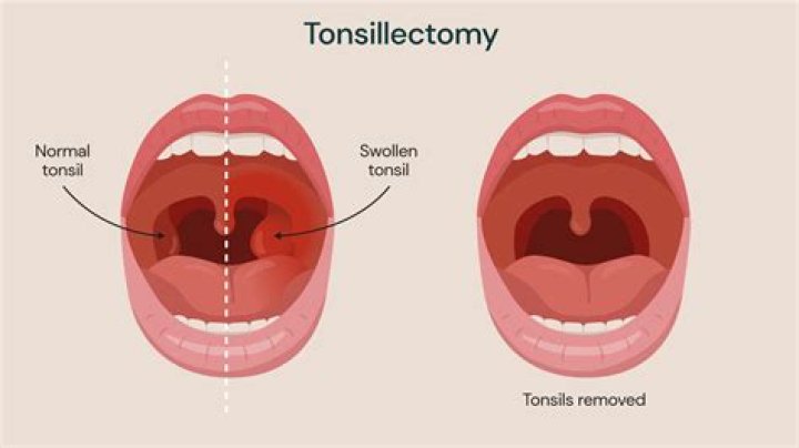 Does removing tonsils stop snoring?