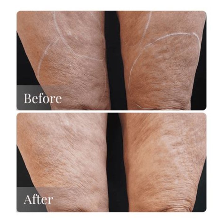 Does Retin-A tighten sagging skin?
