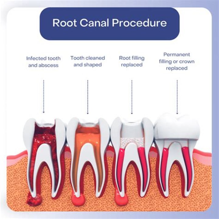 Does root canal hurt more than filling?