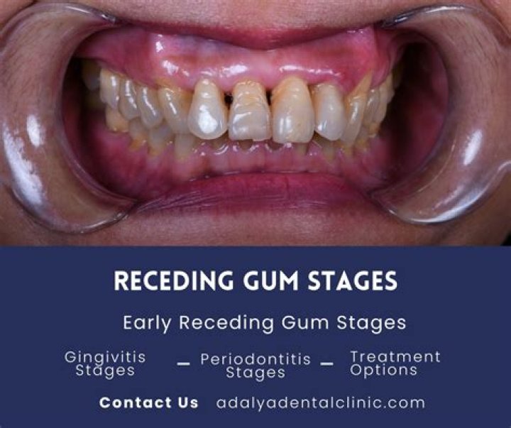 Does Sensodyne help with receding gums?