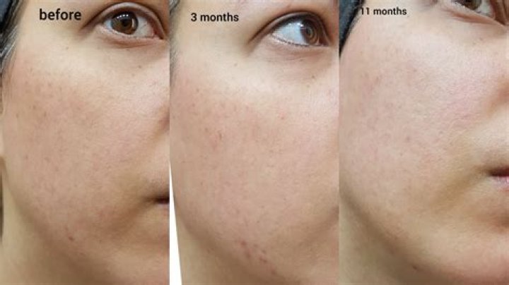 Does tretinoin fade freckles?